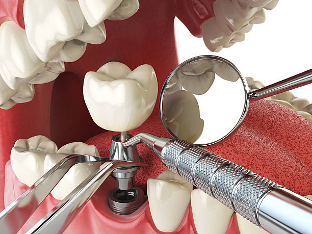 Best Cracked Tooth Emergency Dentist  in Fort Denaud, FL